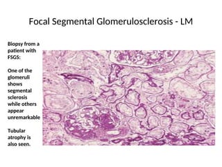 Focal Segmental Glomerulosclerosis - LM
Biopsy from a
patient with
FSGS:
One of the
glomeruli
shows
segmental
sclerosis
while others
appear
unremarkable
Tubular
atrophy is
also seen.
 