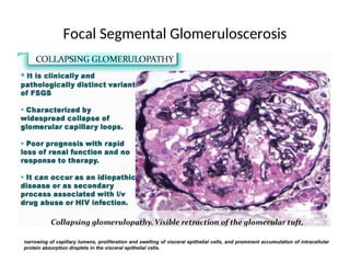 Focal Segmental Glomeruloscerosis
narrowing of capillary lumens, proliferation and swelling of visceral epithelial cells, and prominent accumulation of intracellular
protein absorption droplets in the visceral epithelial cells.
 