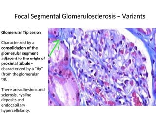 Focal Segmental Glomerulosclerosis – Variants
Glomerular Tip Lesion
Characterized by a
consolidation of the
glomerular segment
adjacent to the origin of
proximal tubule -
characterized by a "tip"
(from the glomerular
tip).
There are adhesions and
sclerosis, hyaline
deposits and
endocapillary
hypercellularity.
 