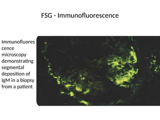 FSG - Immunofluorescence
Immunofluores
cence
microscopy
demonstrating
segmental
deposition of
IgM in a biopsy
from a patient
 