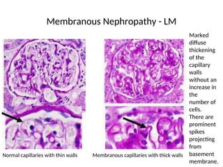 Normal capillaries with thin walls Membranous capillaries with thick walls
Membranous Nephropathy - LM
Marked
diffuse
thickening
of the
capillary
walls
without an
increase in
the
number of
cells.
There are
prominent
spikes
projecting
from
basement
membrane.
 