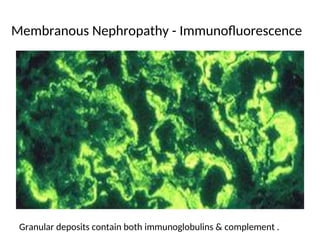 Membranous Nephropathy - Immunofluorescence
Granular deposits contain both immunoglobulins & complement .
 