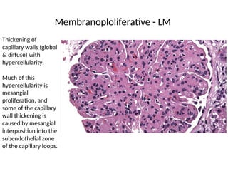 Thickening of
capillary walls (global
& diffuse) with
hypercellularity.
Much of this
hypercellularity is
mesangial
proliferation, and
some of the capillary
wall thickening is
caused by mesangial
interposition into the
subendothelial zone
of the capillary loops.
Membranoploliferative - LM
 