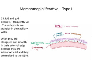 Membranoploliferative – Type I
C3, IgG and IgM
deposits – frequently C3
. These deposits are
granular in the capillary
walls.
Often they are
elongated and smooth
in their external edge
because they are
subendothelial and they
are molded to the GBM.
 