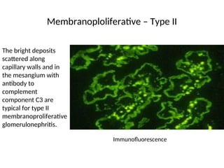 Membranoploliferative – Type II
Immunofluorescence
The bright deposits
scattered along
capillary walls and in
the mesangium with
antibody to
complement
component C3 are
typical for type II
membranoproliferative
glomerulonephritis.
 