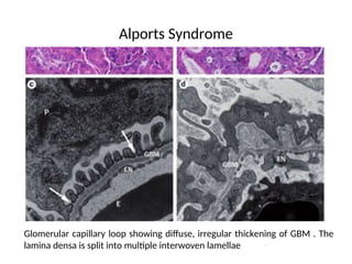 Alports Syndrome
Glomerular capillary loop showing diffuse, irregular thickening of GBM . The
lamina densa is split into multiple interwoven lamellae
 