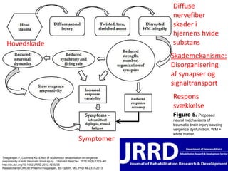 Thiagarajan P, Ciuffreda KJ. Effect of oculomotor rehabilitation on vergence 
responsivity in mild traumatic brain injury. J Rehabil Res Dev. 2013;50(9):1223–40. 
http://dx.doi.org/10.1682/JRRD.2012.12.0235 
ResearcherID/ORCID: Preethi Thiagarajan, BS Optom, MS, PhD: M-2337-2013 
Skademekanisme: 
Disorganisering 
af synapser og 
signaltransport 
Figure 5. Proposed 
neural mechanisms of 
traumatic brain injury causing 
vergence dysfunction. WM = 
white matter. 
14 
Symptomer 
Hovedskade 
Diffuse 
nervefiber 
skader i 
hjernens hvide 
substans 
Respons 
svækkelse 
 
