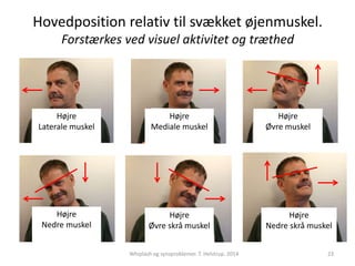 Hovedposition relativ til svækket øjenmuskel. 
Forstærkes ved visuel aktivitet og træthed 
Højre 
Laterale muskel 
Højre 
Mediale muskel 
Højre 
Nedre skrå muskel 
Højre 
Øvre skrå muskel 
Højre 
Nedre muskel 
Højre 
Øvre muskel 
Whiplash og synsproblemer. T. Helstrup. 2014 23 
 