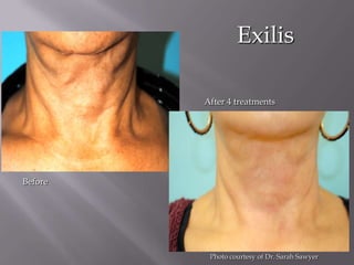 Exilis

         After 4 treatments




Before




          Photo courtesy of Dr. Sarah Sawyer
 