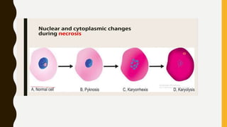 Wallerian degenratin