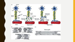 Wallerian degenratin