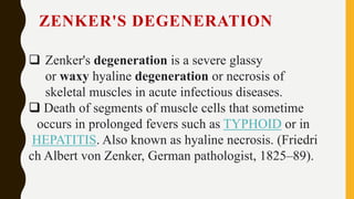 Wallerian degenratin