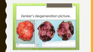 Wallerian degenratin