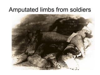Amputated limbs from soldiers
 
