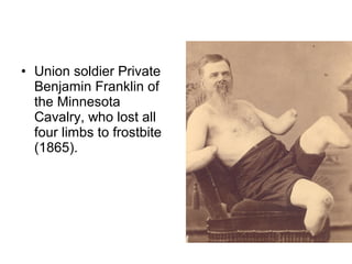 • Union soldier Private
Benjamin Franklin of
the Minnesota
Cavalry, who lost all
four limbs to frostbite
(1865).
 