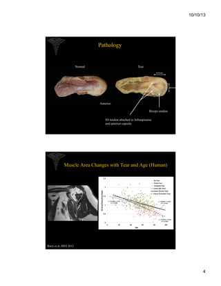 10/10/13

Pathology

Normal

Tear
47.72 mm

30.47mm

Anterior
Biceps tendon
SS tendon attached to Infraspinatus
and anterior capsule

Muscle Area Changes with Tear and Age (Human)

Barry et al, JSES 2012	


4

 