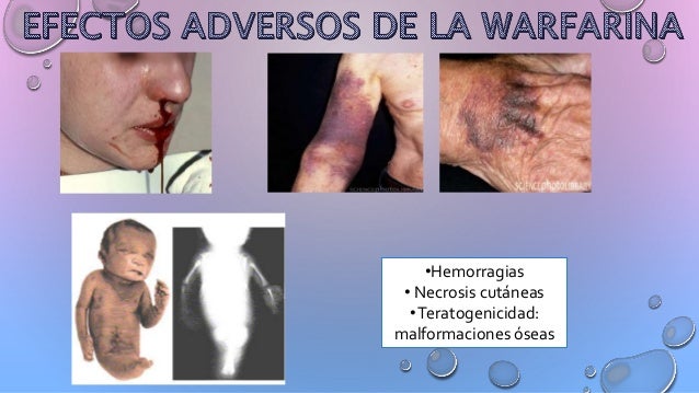 WARFARINA EN EL EMBARAZO DOWNLOAD WARFARINA EN EL EMBARAZO DOWNLOAD