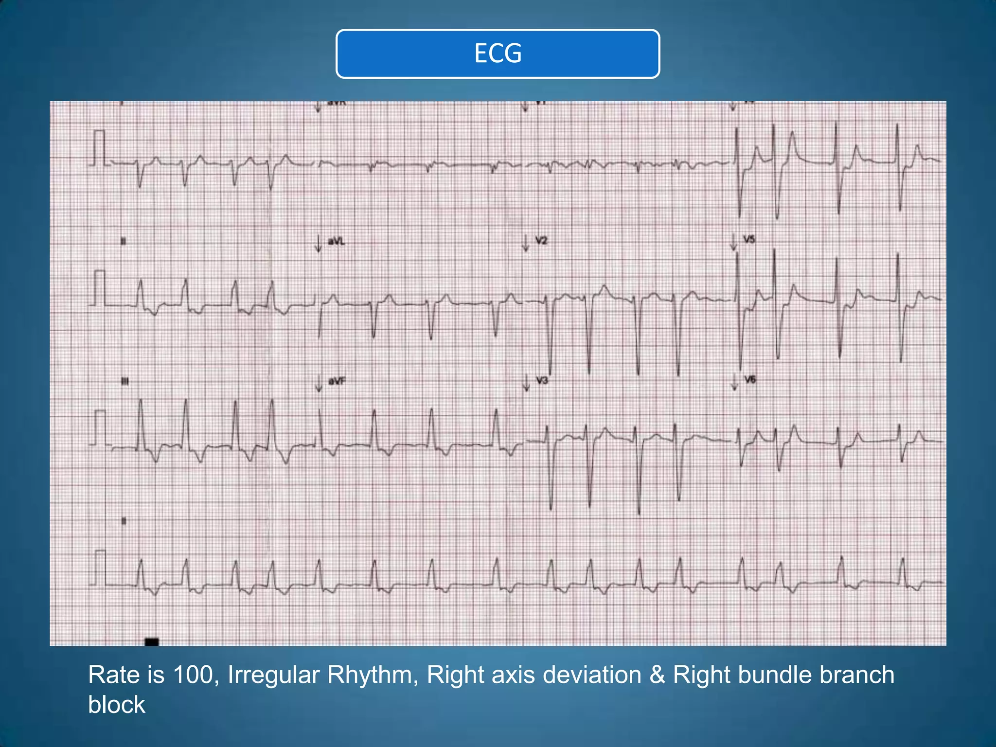 ECG




Rate is 100, Irregular Rhythm, Right axis deviation & Right bundle branch
block
 