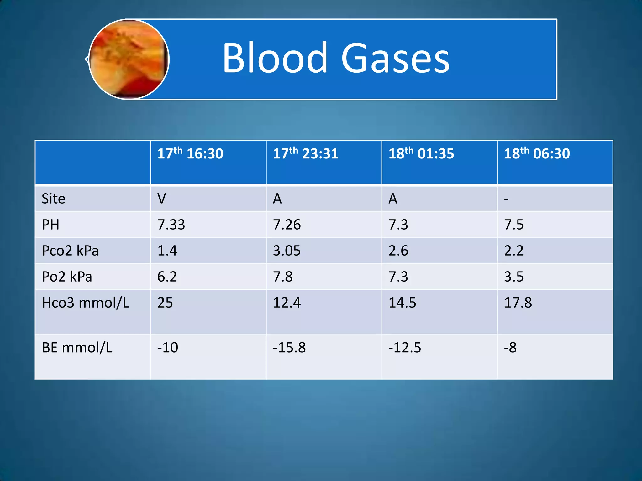 Blood Gases
              17th 16:30   17th 23:31   18th 01:35   18th 06:30

Site          V            A            A            -
PH            7.33         7.26         7.3          7.5
Pco2 kPa      1.4          3.05         2.6          2.2
Po2 kPa       6.2          7.8          7.3          3.5
Hco3 mmol/L   25           12.4         14.5         17.8

BE mmol/L     -10          -15.8        -12.5        -8
 
