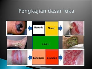 Infeksi
Epitelisasi Granulasi
SloughNecrotic
 