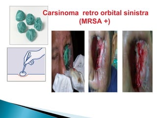 Carsinoma retro orbital sinistra
(MRSA +)
 