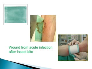 Wound from acute infection
after insect bite
 