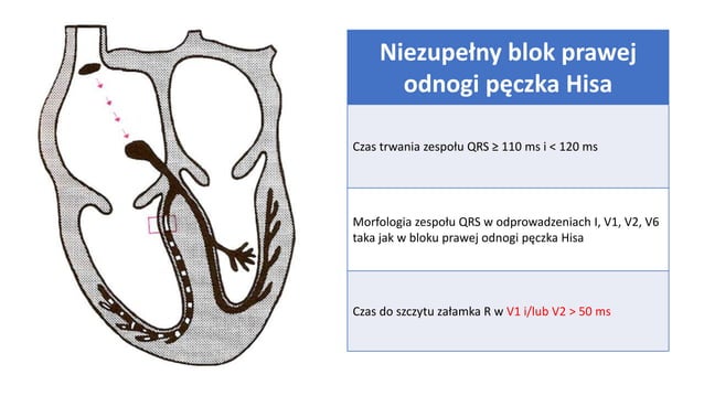 Warsztaty ekg cz. 1 zaburzenia przewodzenia | PPTX