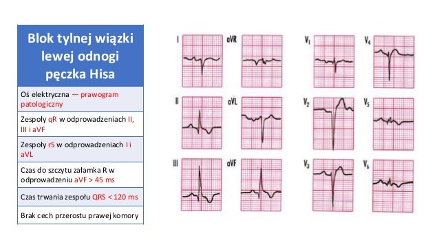 Blok Przedniej Wiązki Lewej Odnogi Pęczka Hisa www.slideshare.net