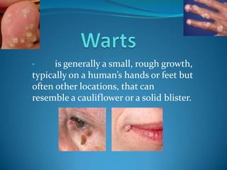 •     is generally a small, rough growth,
typically on a human’s hands or feet but
often other locations, that can
resemble a cauliflower or a solid blister.
 