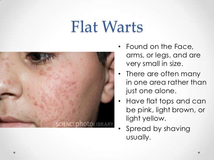 flat warts on legs #11