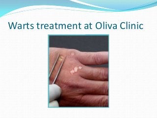 Warts treatment at Oliva Clinic
 