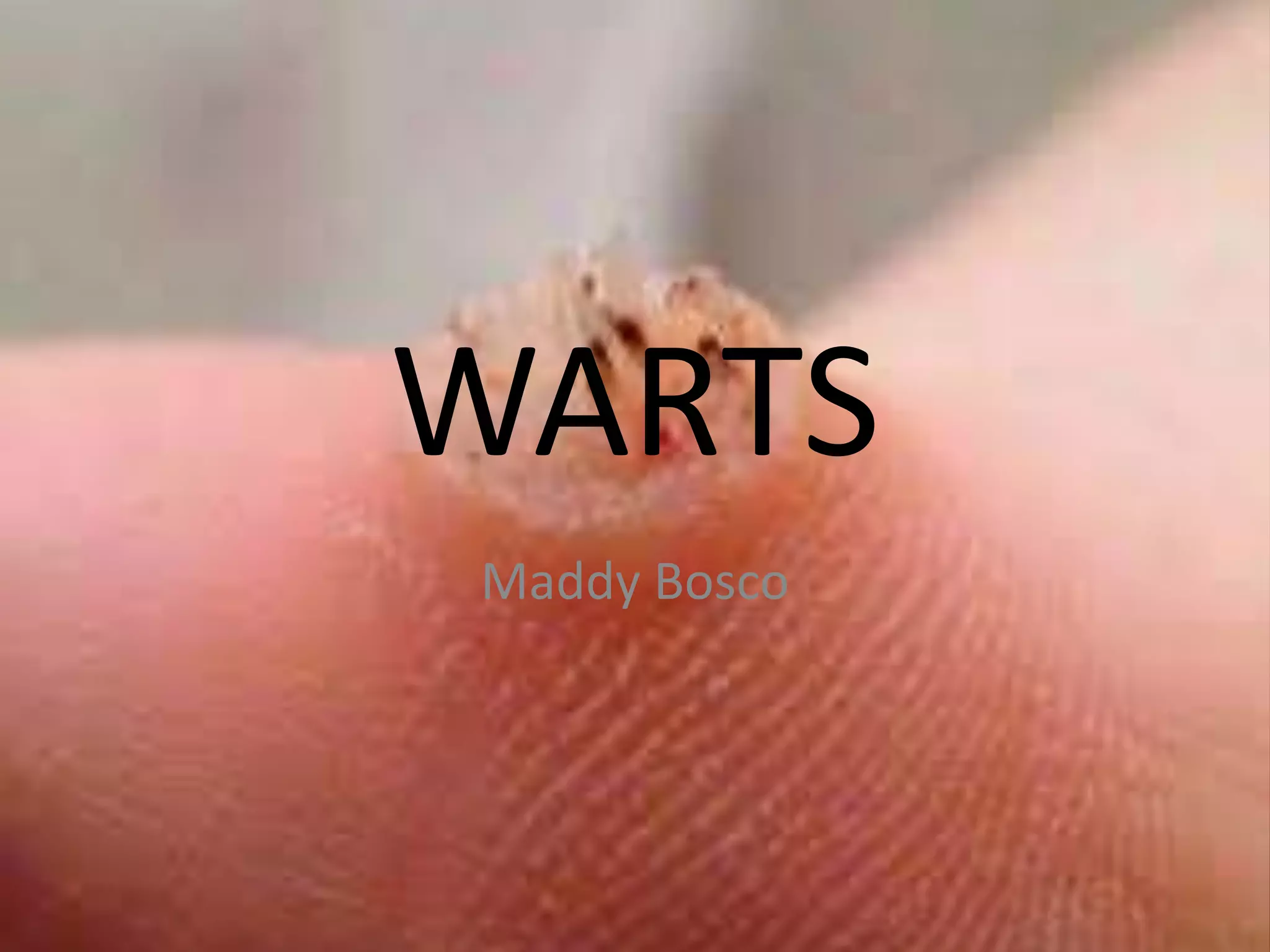 Warts PPT
