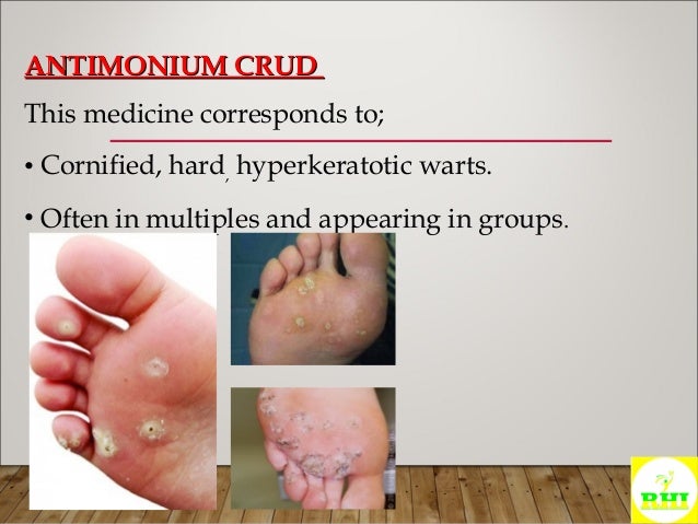 Homeopathic Treatment Of WARTS And MOLLUSCUM