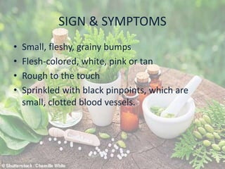 SIGN & SYMPTOMS
• Small, fleshy, grainy bumps
• Flesh-colored, white, pink or tan
• Rough to the touch
• Sprinkled with black pinpoints, which are
small, clotted blood vessels.
 