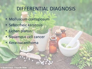 DIFFERENTIAL DIAGNOSIS
• Molluscum contagiosum
• Seborrheic keratosis
• Lichen planus
• Squamous cell cancer
• Keratoacanthoma
 