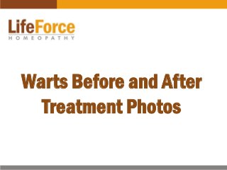 Warts Before and After
Treatment Photos
 