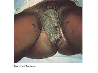 Condyloma Acuminata
 