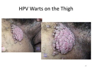 HPV Warts on the Thigh
24
 