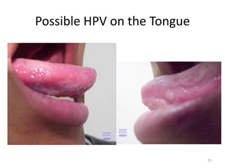 Possible HPV on the Tongue
25
 