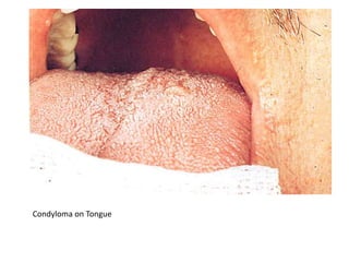 Condyloma on Tongue
 