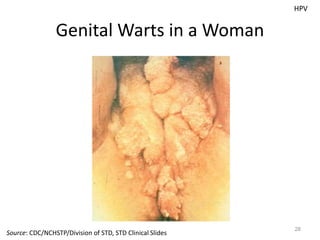 Genital Warts in a Woman
28
HPV
Source: CDC/NCHSTP/Division of STD, STD Clinical Slides
 