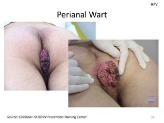 Perianal Wart
29Source: Cincinnati STD/HIV Prevention Training Center
HPV
 