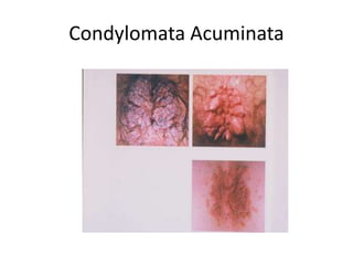 Condylomata Acuminata
 