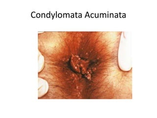 Condylomata Acuminata
 