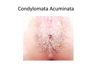 Condylomata Acuminata
 