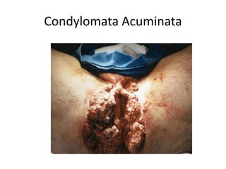 Condylomata Acuminata
 