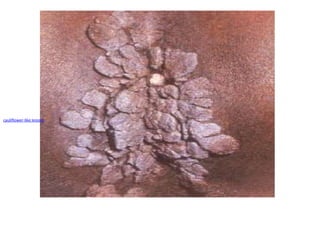 cauliflower-like lesions
 