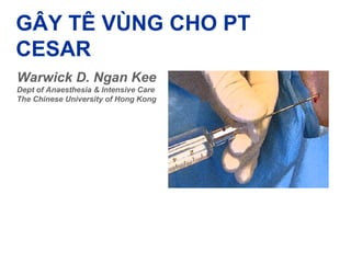 GÂY TÊ VÙNG CHO PT 
CESAR 
Warwick D. Ngan Kee 
Dept of Anaesthesia & Intensive Care 
The Chinese University of Hong Kong 
 