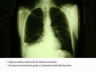  Silueta cardiaca dentro de los límites normales.
 Se aprecia neumotórax grado 3 y hemotórax del lado derecho.
 