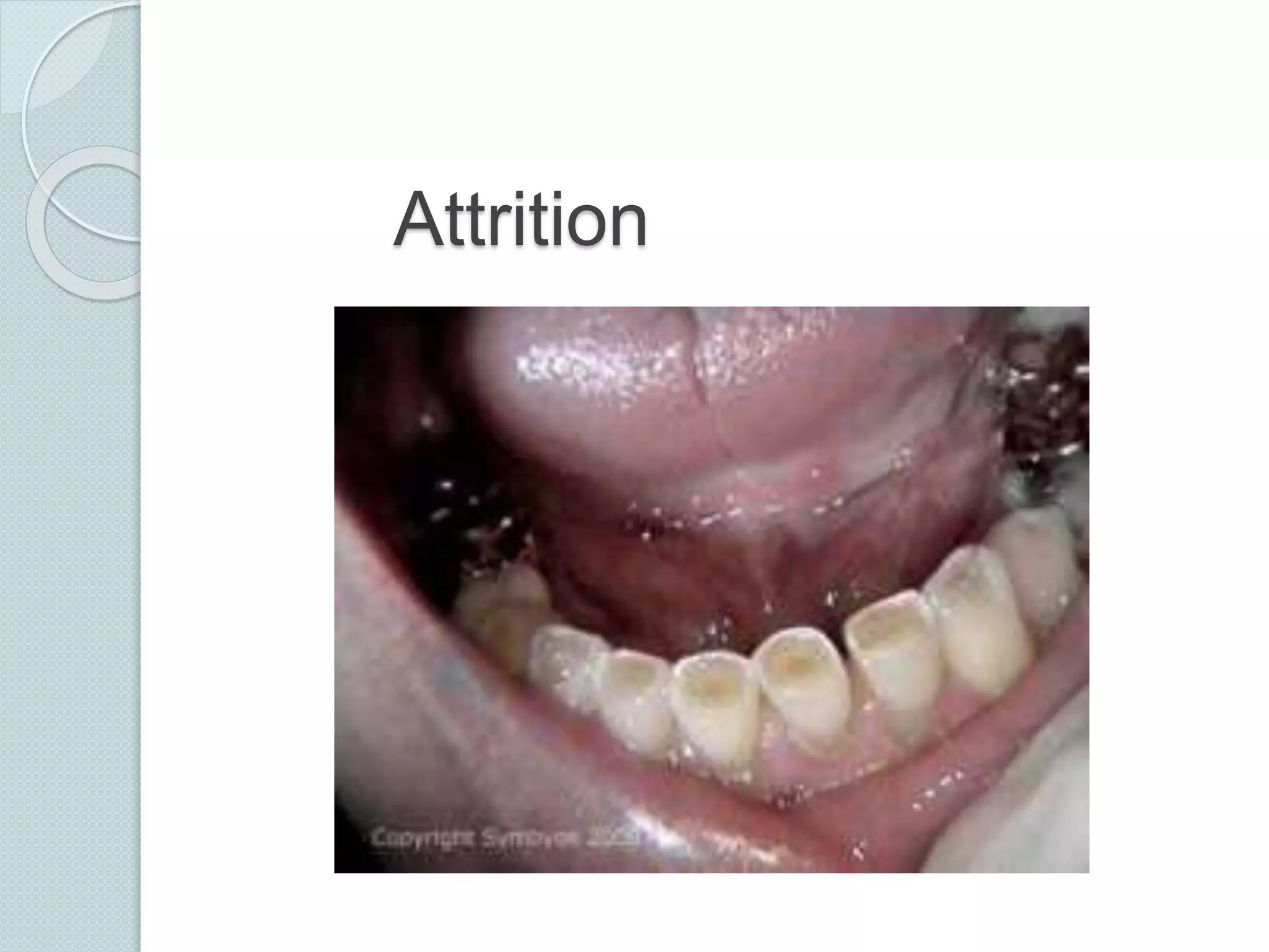 Wasting diseases of teeth final | PPTX